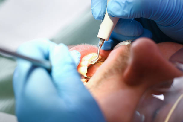 Best Emergency Wisdom Tooth Extraction in Falmouth, VA