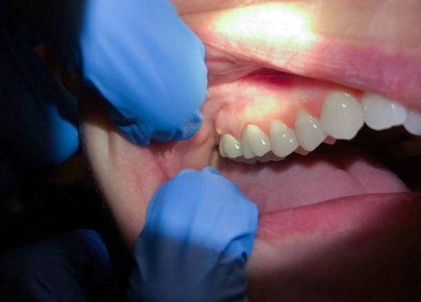 Best Dental Abscess Treatment in Falmouth, VA